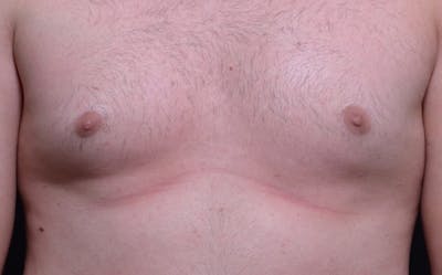 CoolSculpting Before & After Gallery - Patient 259429 - Image 1