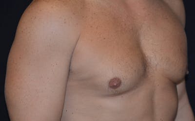CoolSculpting Before & After Gallery - Patient 586565 - Image 2