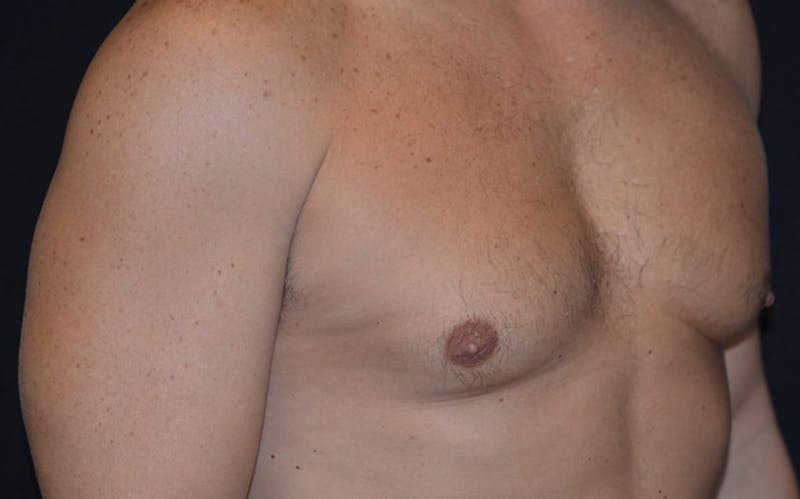 CoolSculpting Before & After Gallery - Patient 586565 - Image 2