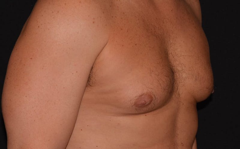 CoolSculpting Before & After Gallery - Patient 586565 - Image 1
