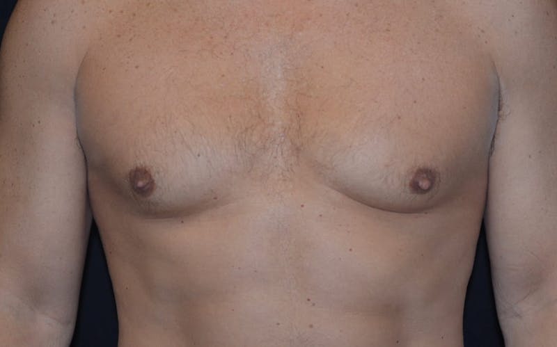 CoolSculpting Before & After Gallery - Patient 586565 - Image 4