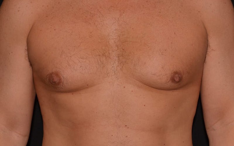 CoolSculpting Before & After Gallery - Patient 586565 - Image 3