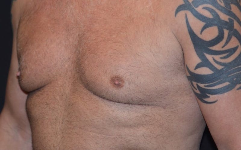 CoolSculpting Before & After Gallery - Patient 363360 - Image 1