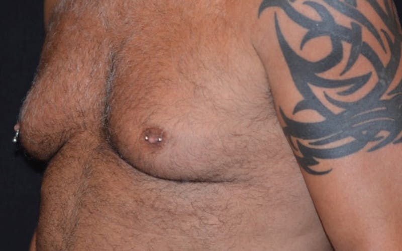 CoolSculpting Before & After Gallery - Patient 363360 - Image 2