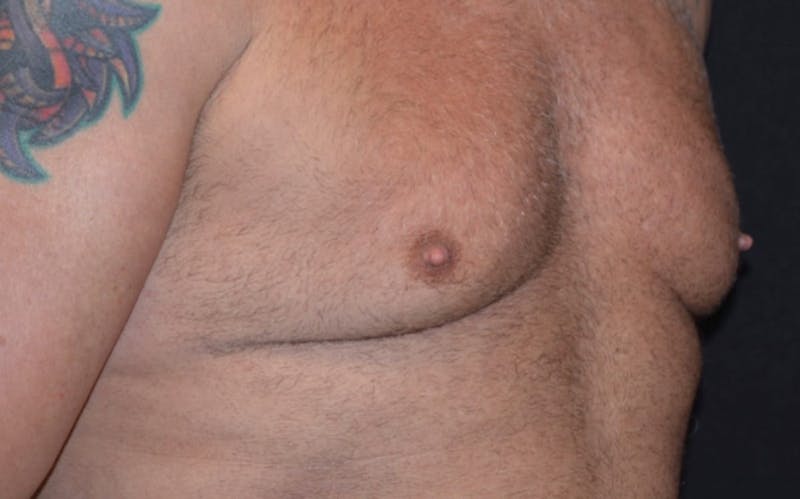 CoolSculpting Before & After Gallery - Patient 363360 - Image 3