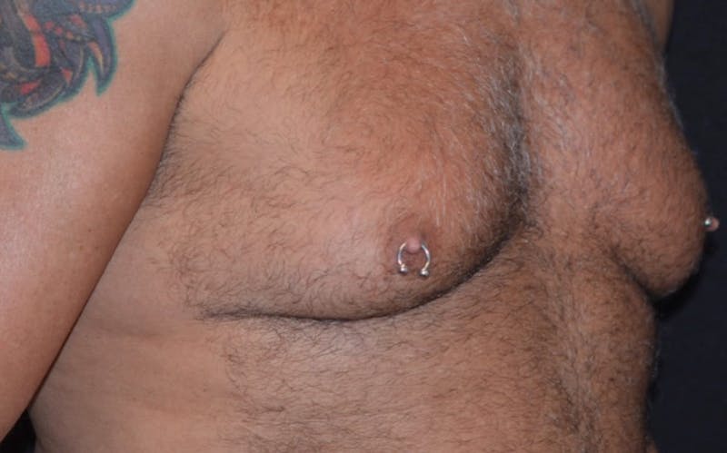 CoolSculpting Before & After Gallery - Patient 363360 - Image 4