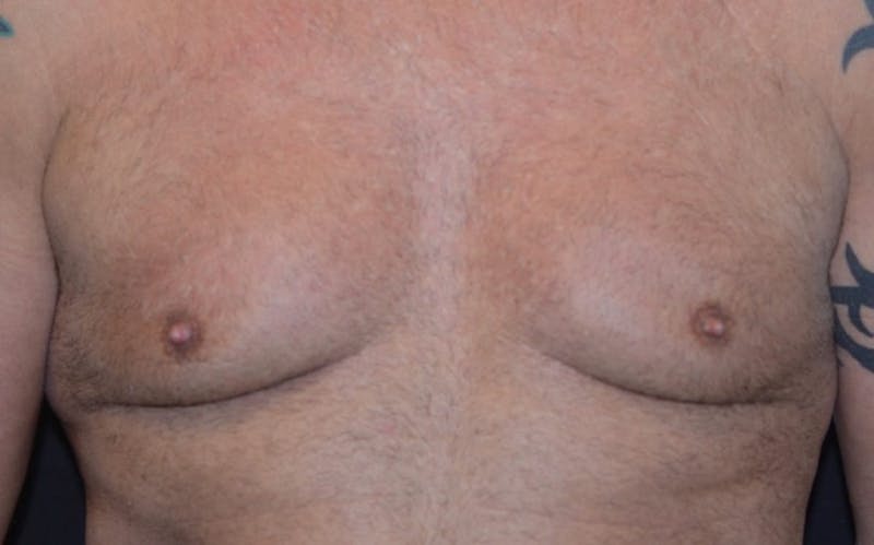 CoolSculpting Before & After Gallery - Patient 363360 - Image 5