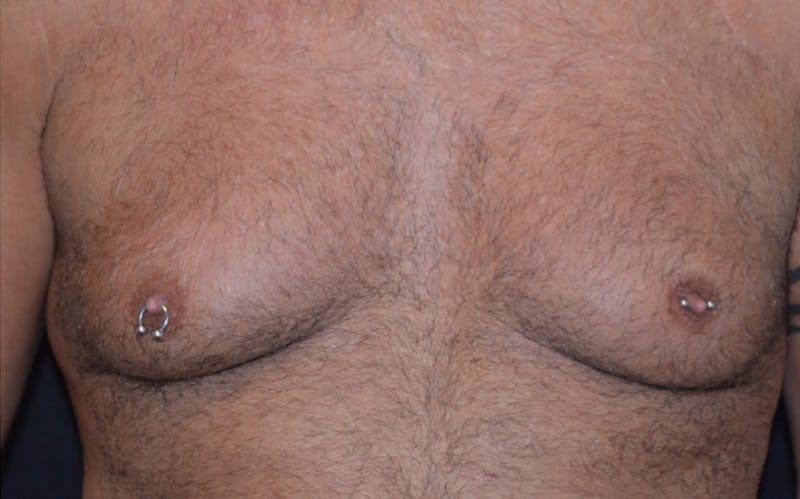 CoolSculpting Before & After Gallery - Patient 363360 - Image 6