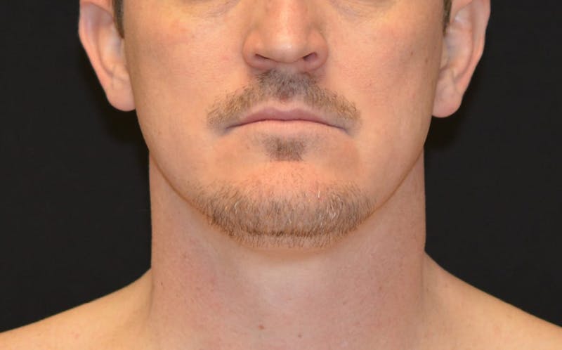 CoolSculpting Before & After Gallery - Patient 808126 - Image 2