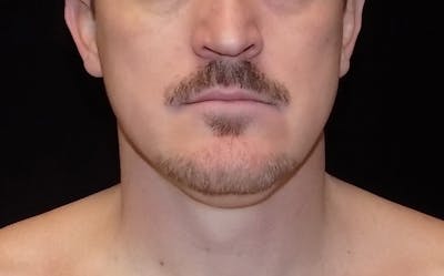 CoolSculpting Before & After Gallery - Patient 808126 - Image 1