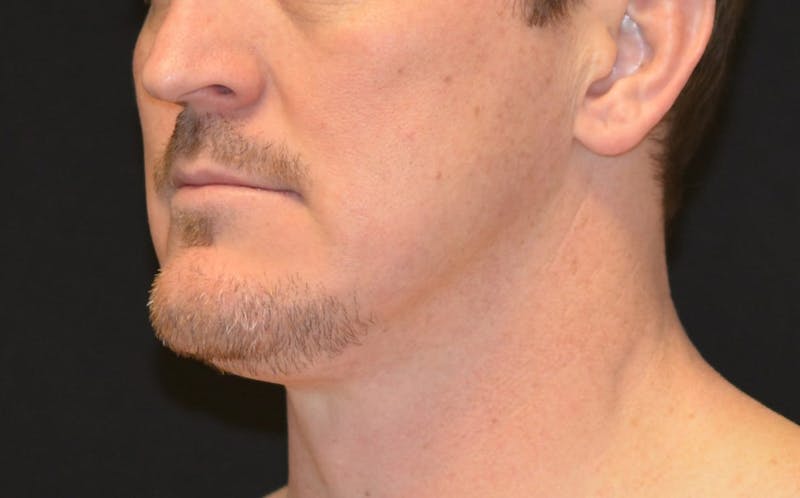 CoolSculpting Before & After Gallery - Patient 808126 - Image 4