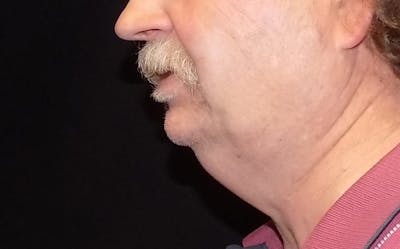 CoolSculpting Before & After Gallery - Patient 392005 - Image 1