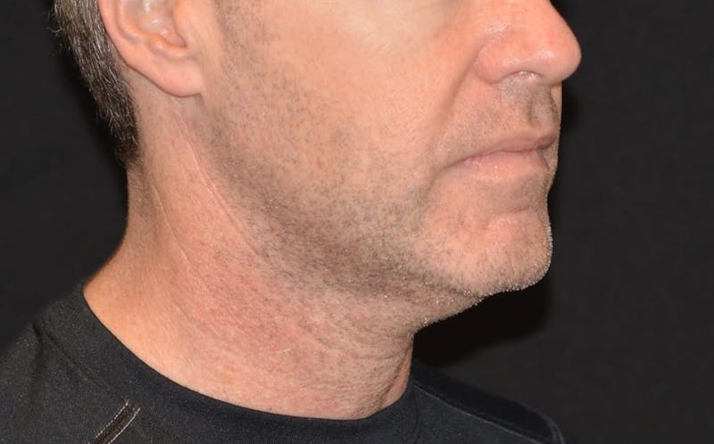 CoolSculpting Before & After Gallery - Patient 372675 - Image 2