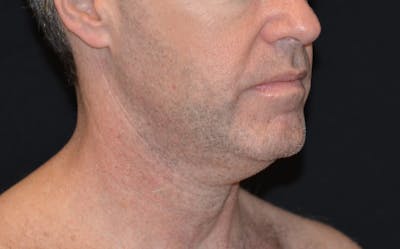 CoolSculpting Before & After Gallery - Patient 372675 - Image 1