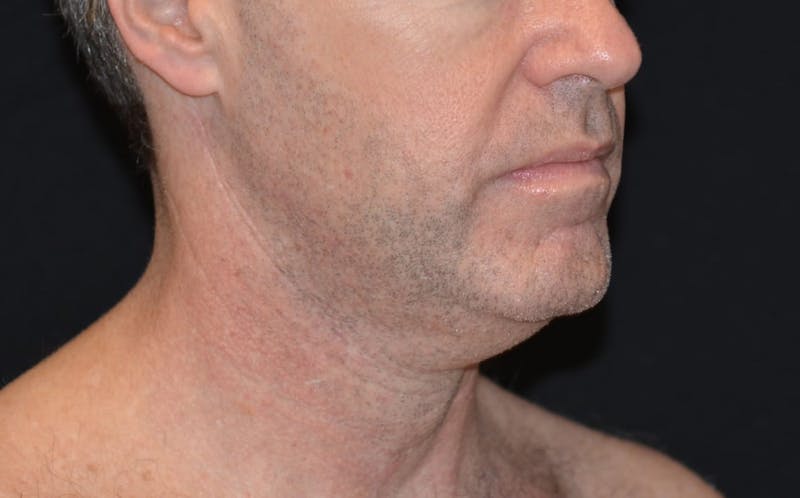 CoolSculpting Before & After Gallery - Patient 372675 - Image 1