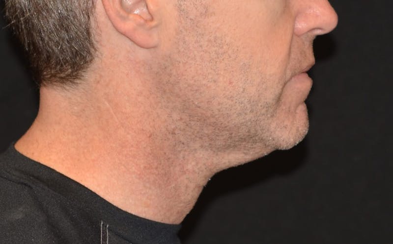 CoolSculpting Before & After Gallery - Patient 372675 - Image 4