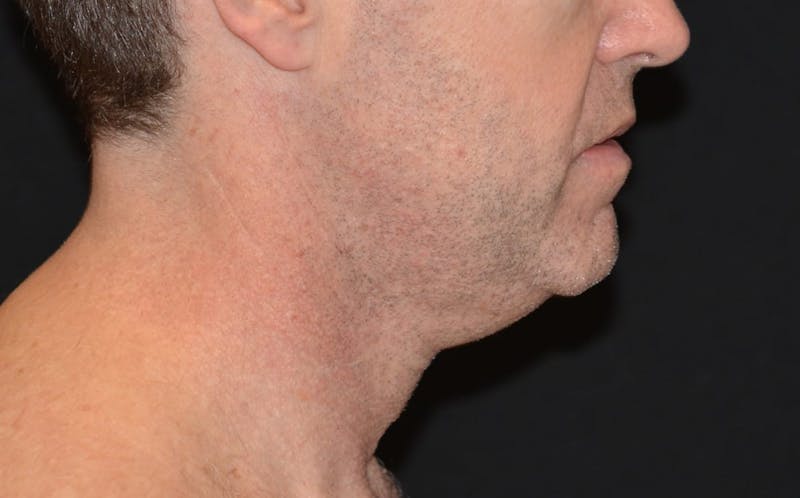 CoolSculpting Before & After Gallery - Patient 372675 - Image 3