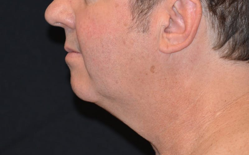 CoolSculpting Before & After Gallery - Patient 309717 - Image 2