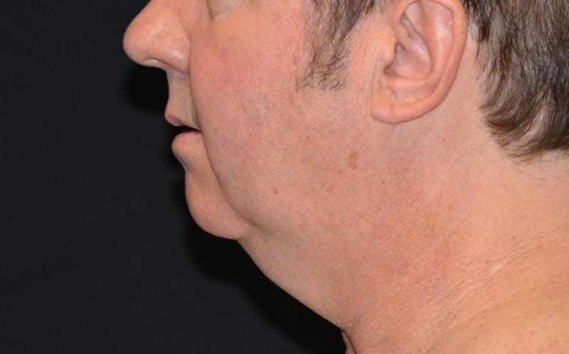 CoolSculpting Before & After Gallery - Patient 309717 - Image 1