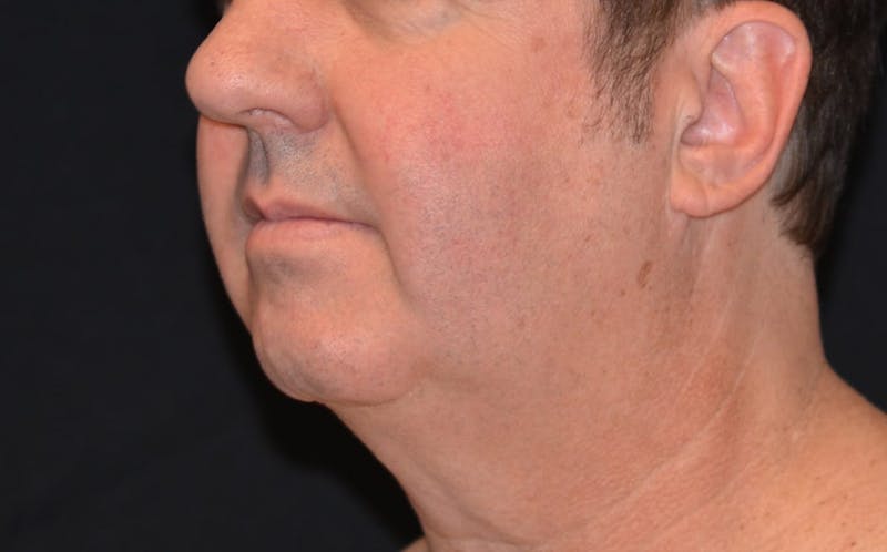 CoolSculpting Before & After Gallery - Patient 309717 - Image 4