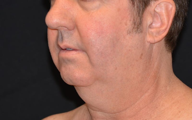 CoolSculpting Before & After Gallery - Patient 309717 - Image 3