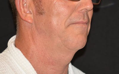 CoolSculpting Before & After Gallery - Patient 869243 - Image 2
