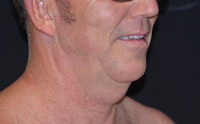 CoolSculpting Before & After Gallery - Patient 869243 - Image 1