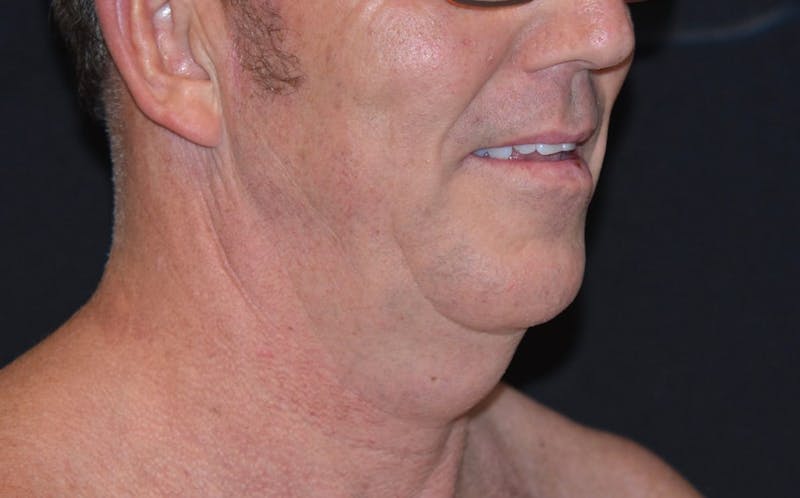 CoolSculpting Before & After Gallery - Patient 869243 - Image 1