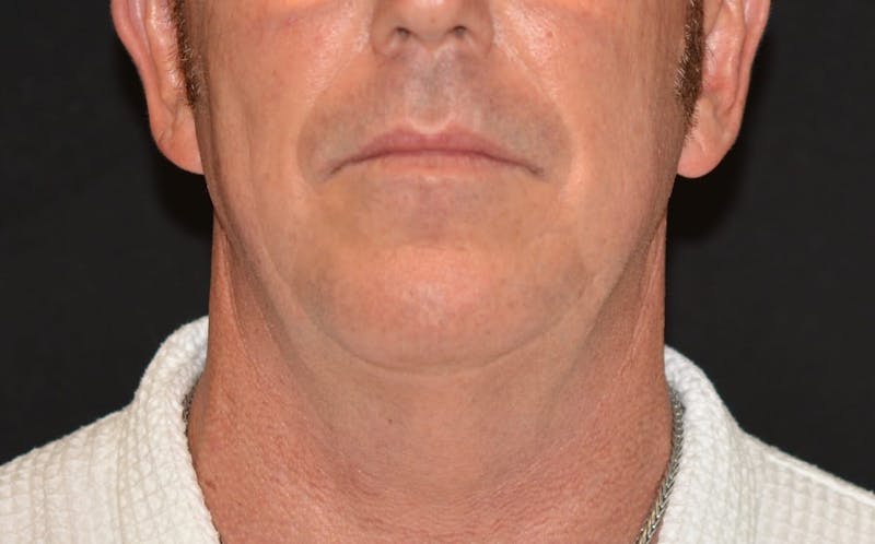 CoolSculpting Before & After Gallery - Patient 869243 - Image 4