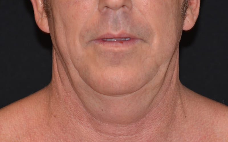 CoolSculpting Before & After Gallery - Patient 869243 - Image 3