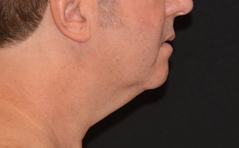CoolSculpting Before & After Gallery - Patient 141971 - Image 2