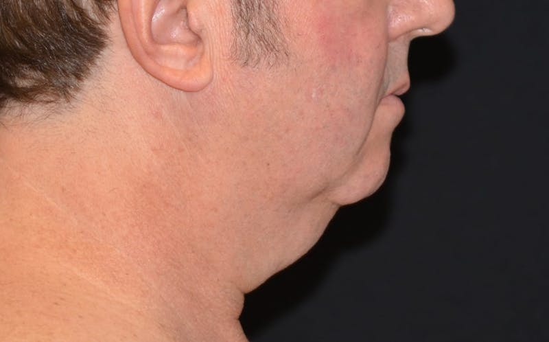 CoolSculpting Before & After Gallery - Patient 141971 - Image 1