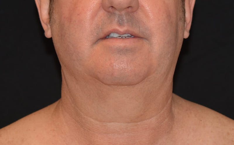 CoolSculpting Before & After Gallery - Patient 141971 - Image 4