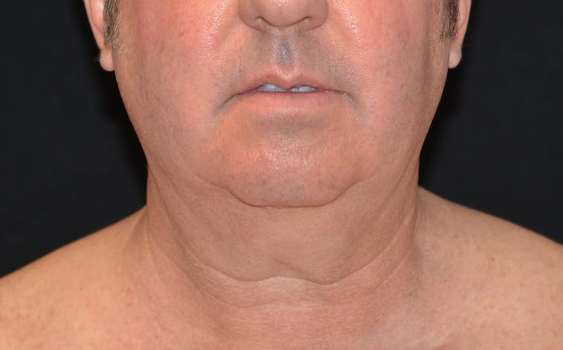 CoolSculpting Before & After Gallery - Patient 141971 - Image 3
