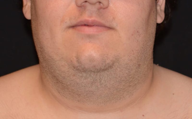 CoolSculpting Before & After Gallery - Patient 105945 - Image 2