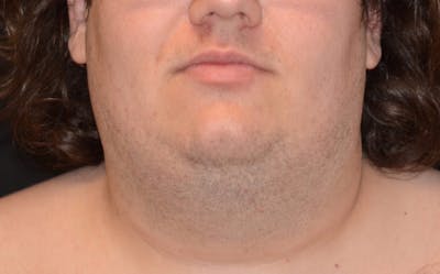 CoolSculpting Before & After Gallery - Patient 105945 - Image 1