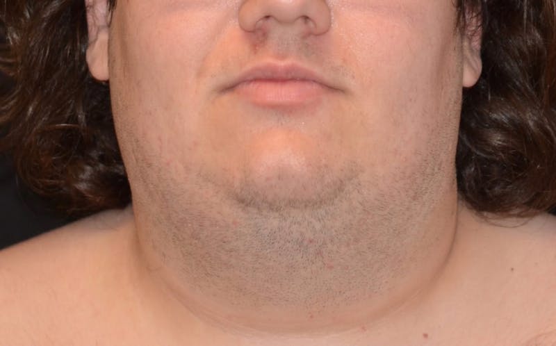 CoolSculpting Before & After Gallery - Patient 105945 - Image 1
