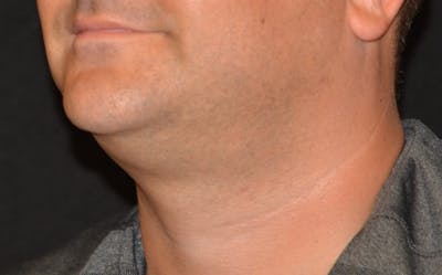 CoolSculpting Before & After Gallery - Patient 314032 - Image 2