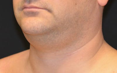 CoolSculpting Before & After Gallery - Patient 314032 - Image 1