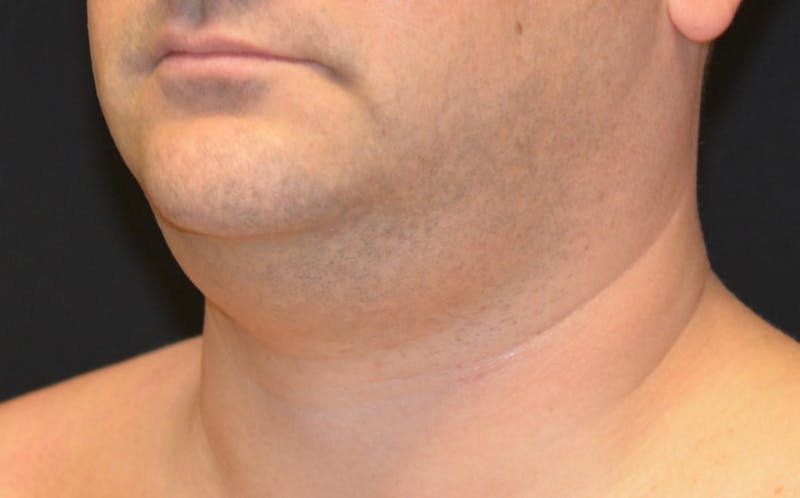 CoolSculpting Before & After Gallery - Patient 314032 - Image 1