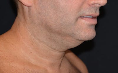 CoolSculpting Before & After Gallery - Patient 783978 - Image 2