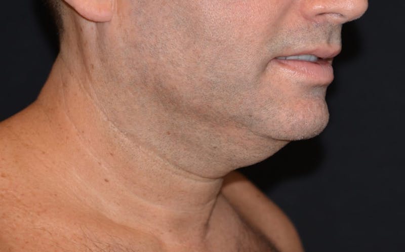 CoolSculpting Before & After Gallery - Patient 783978 - Image 2