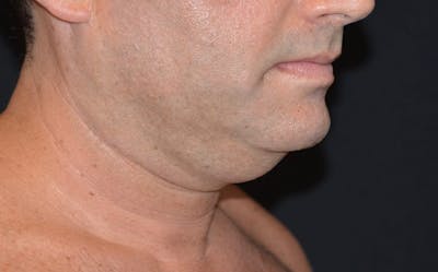 CoolSculpting Before & After Gallery - Patient 783978 - Image 1