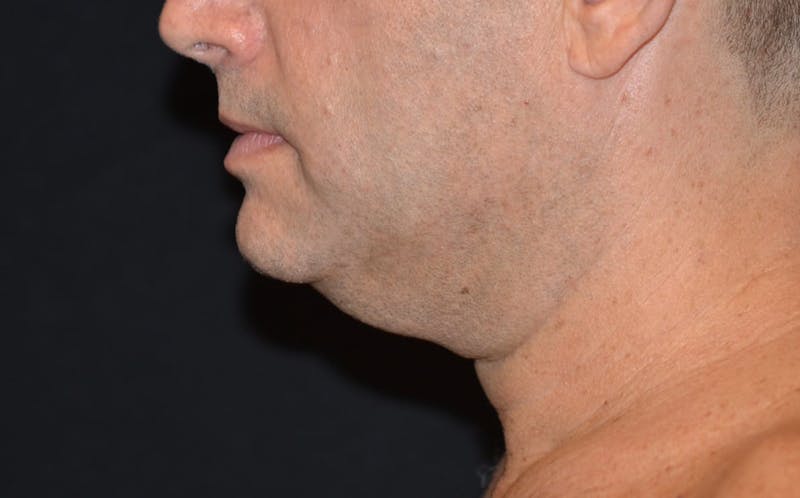 CoolSculpting Before & After Gallery - Patient 783978 - Image 4