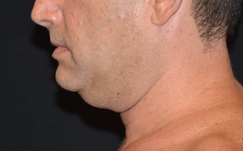CoolSculpting Before & After Gallery - Patient 783978 - Image 3