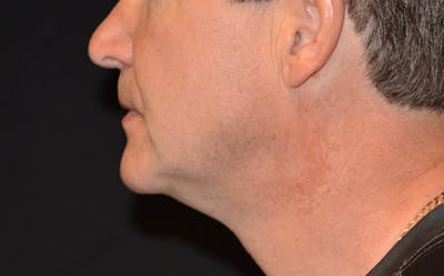 CoolSculpting Before & After Gallery - Patient 864257 - Image 2