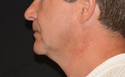 CoolSculpting Before & After Gallery - Patient 864257 - Image 1