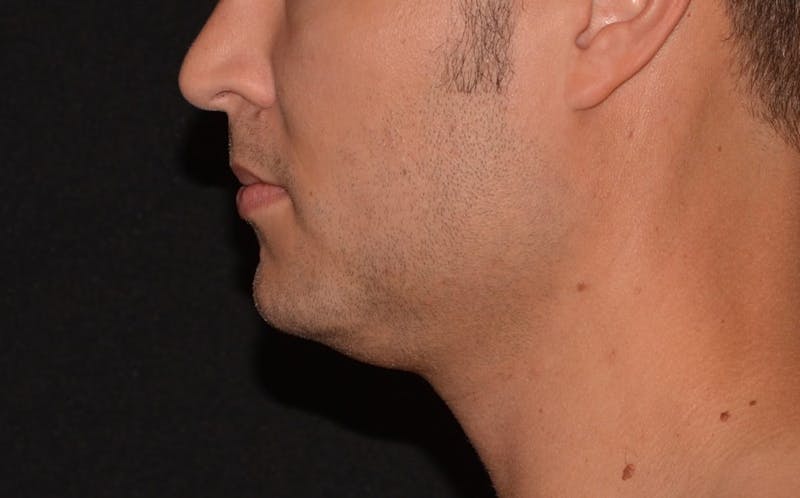 CoolSculpting Before & After Gallery - Patient 330919 - Image 2