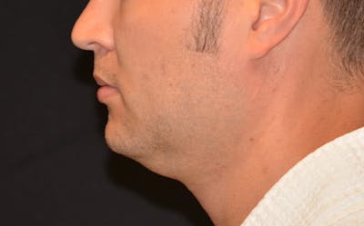 CoolSculpting Before & After Gallery - Patient 330919 - Image 1