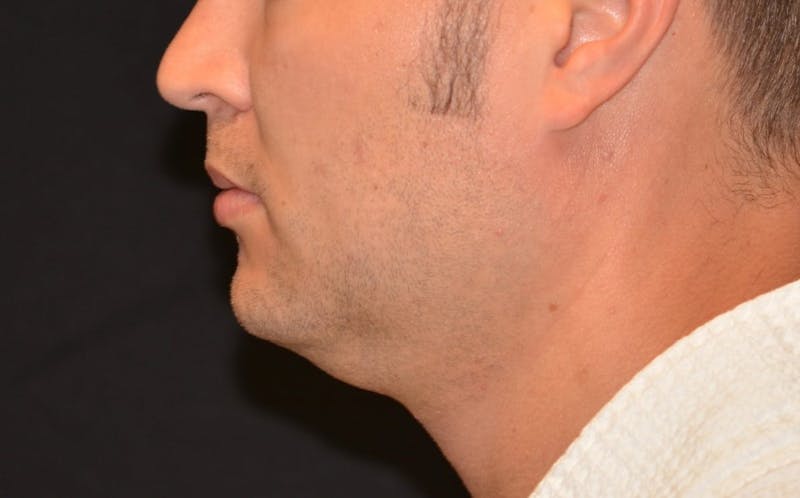 CoolSculpting Before & After Gallery - Patient 330919 - Image 1